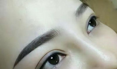全切双眼皮增生多久能下去(全切双眼皮的手术方法)