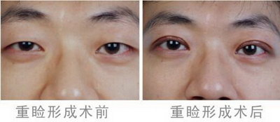 眼睛一大一小:改善全世界的问题_纹眼线后眼睛肿了可以冰敷吗