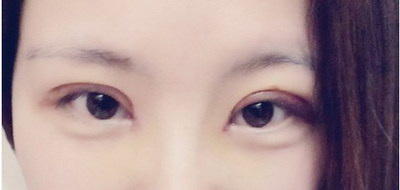 眼皮吸脂后多久能恢复(眼皮吸脂多久可以恢复)