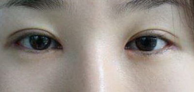 淡化眼袋最有效的方法_去眼袋加提拉手术视频