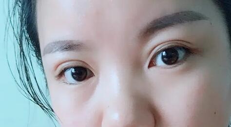 做微创手术后要吃什么(妇科微创手术后吃什么恢复快)