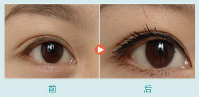 肿眼泡和单眼皮的区别(肿眼泡与单眼皮的区别)