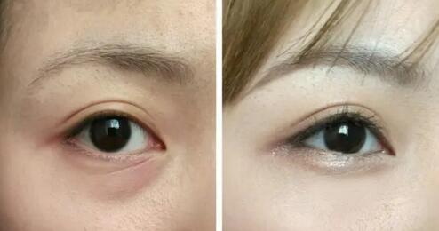 眼睑下至手术前后(上眼睑下垂手术前后)