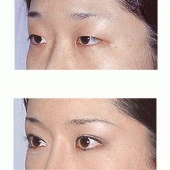 济南割双眼皮美莲(济南美莲双眼皮价格)