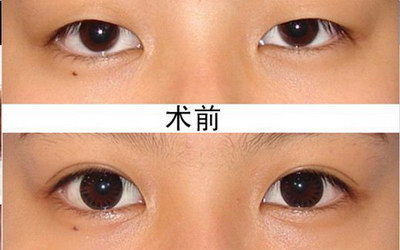 做完眼线后眼睛充血_纹眼线眼睛会看不清楚吗