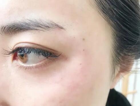割了双眼皮后眼睛肿是什么原因?