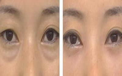 开内眼角会回缩怎么办