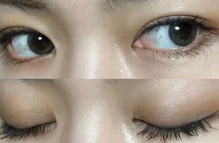 双眼皮冰敷睁眼还是闭眼(刚做完双眼皮应该多睁眼还是闭眼)