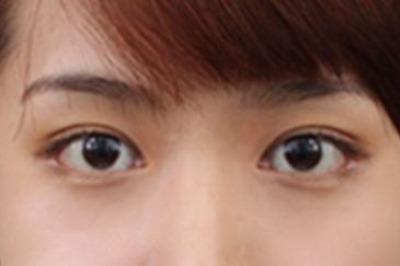 轻度内眦赘皮需要开眼角吗?