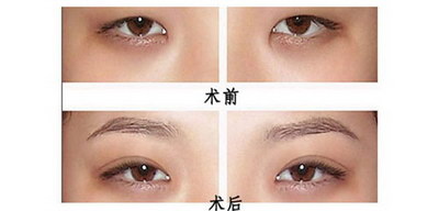 爸爸是单眼皮妈妈是双眼皮生出来的孩子