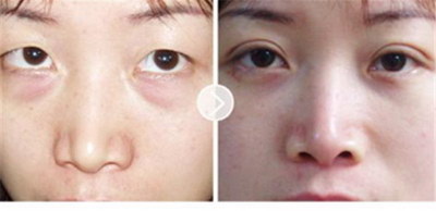 割双眼皮注意事项都有什么啦？