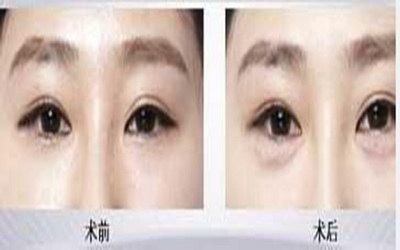 眼角里面长了个小米粒(眼角里面长了个小米粒)