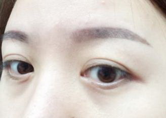 怎么样去掉眼角的纹_注射眼角皱纹除皱