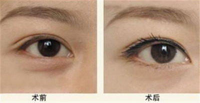 做双眼皮手术的效果好不好？