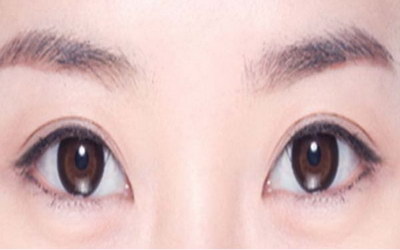 双眼皮改窄容易吗(双眼皮宽改窄容易吗)