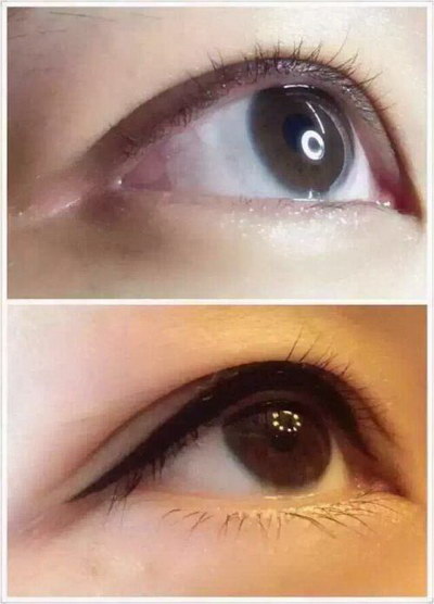 肿眼泡消除手术安全吗