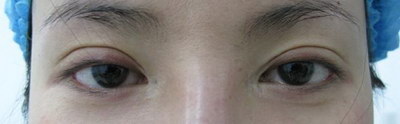 秀眼睛的文案_纹完眼线眼睛红肿用吃消炎药吗