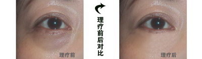 肿眼泡可以埋线吗(肿眼泡可以做埋线吗)