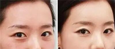 夏天可以做眼线吗_怎么去纹眼线