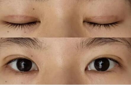 做双眼皮埋线多长时间能恢复正常(埋线双眼皮多长时间能恢复正常)