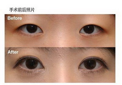 双眼皮变深了是怎么回事