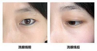割双眼皮能吃葱吗?