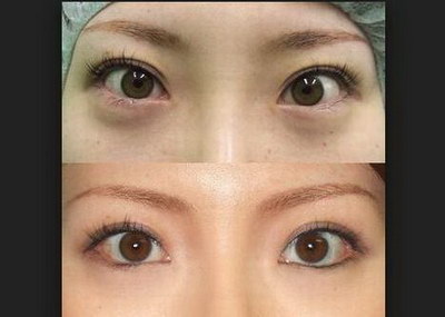 成都眼部整型_如何去除眼部细纹