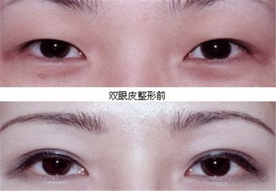 双眼皮5mm算多吗(什么是双眼皮5mm？)
