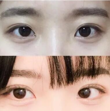 天生卧蚕消失的原因(天生卧蚕消失的原因)