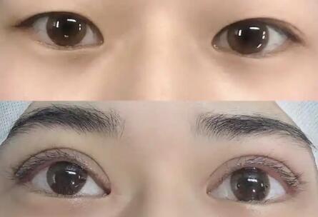眼睛下面的皱纹用什么医美可以解决(眼睛下面皱纹越来越严重什么原因)