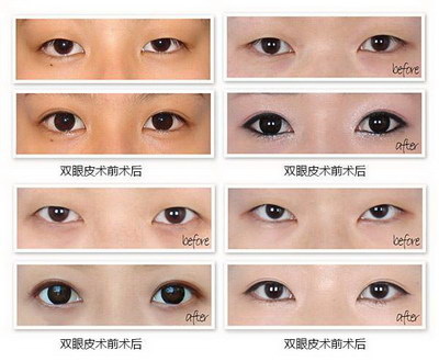 女人眼皮下面长斑是怎么造成的(女人眼皮下垂了该怎么办)