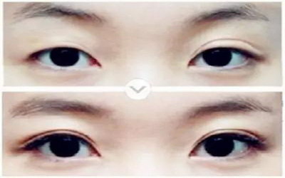 怎么样才能去眼角斑_快速去眼角鱼尾纹办法