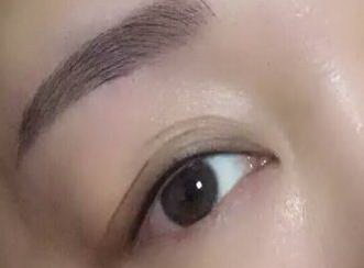 割完双眼皮后疤痕明显怎么办「割完双眼皮发炎了怎么办呢」