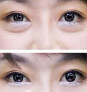 开眼角为什么眼睛小了