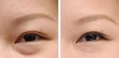 剖腹产多久可以割双眼皮(剖腹产的恢复时间)