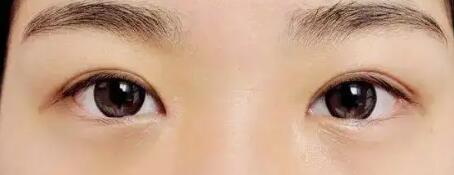 做完双眼皮手术后伤口脱皮有影响吗
