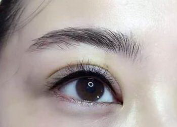 割双眼皮拆线之后需要抹药吗(割双眼皮之后几天拆线)