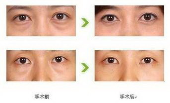 开眼角和割双眼皮恢复时间(割双眼皮开眼角恢复多长时间)