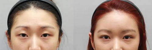 双眼皮拆线后消肿快吗(双眼皮拆线后会消肿吗)
