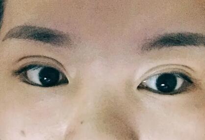 割双眼皮为什么要多睁眼往上看呢(为什么要多睁眼往上看？)