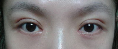 外切眼袋手术拆线后眼角有鼓包(外切眼袋手术几天拆线)