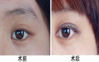 内双眼皮可以割成外双吗