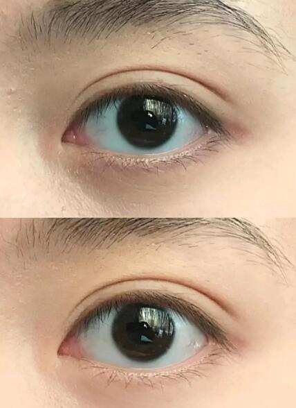 开眼角术后需要祛疤吗