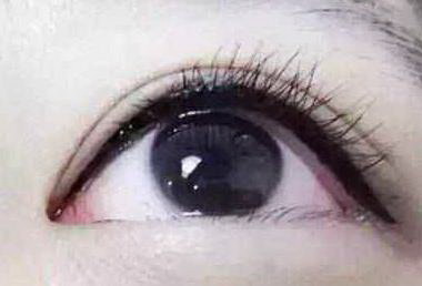 开眼角哪种方法比较好_开眼角哪种方法最好