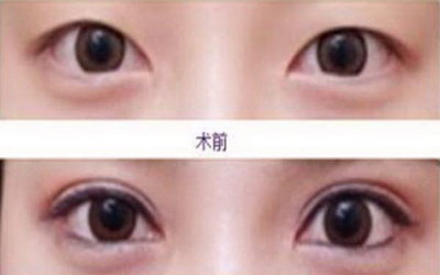 治疗近视眼手术的较好年龄