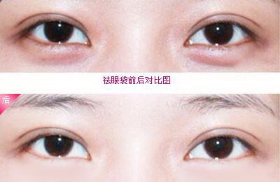 30岁眼睛下面长斑(眼睛下面开始长斑)