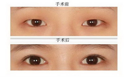 眼袋大有点黑怎么回事「我的眼袋有点下垂啊是怎么回事啊」
