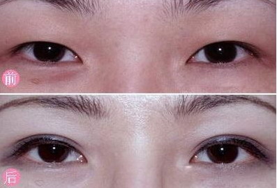 做近视眼手术去哪个医院好(大庆近视眼手术哪个医院好)