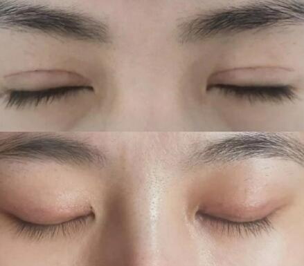觉得割了双眼皮看不出来时该如何？