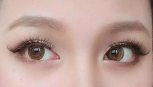 维生素k治疗黑眼圈(维生素K：治疗黑眼圈的神奇法宝)